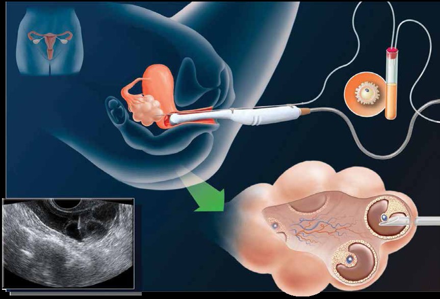 images/embriologi/imbasan semasa pemindahan embrio.jpg